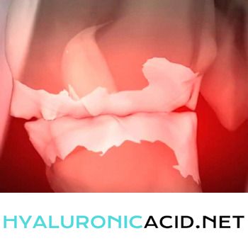 Hyaluronic Acid Osteoarthritis Detail