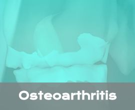 Information about Osteoarthritis